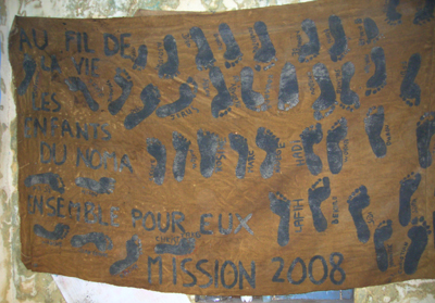 Footprints of children with Noma